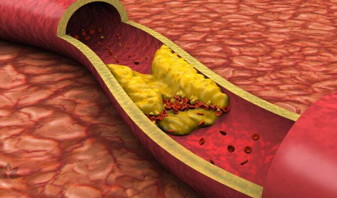 Cholesterol - tichý zabiják