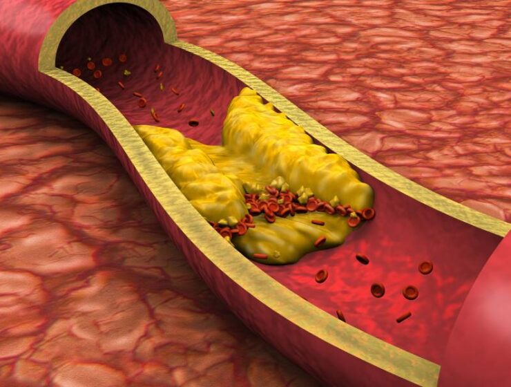 Cholesterol - tichý zabiják